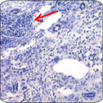 B cells and T cells infiltrate the liver during HCV infection. A lymphoid aggregate is indicated with an arrow. 