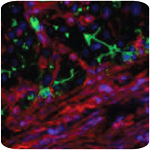 HCV causes liver disease such as fibrosis and cirrhosis. Fibrotic areas in an infected liver are shown in red.